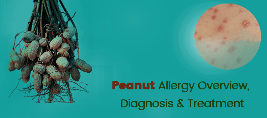 Peanut-Allergy-Overview,-Diagnosis- and- Treatment